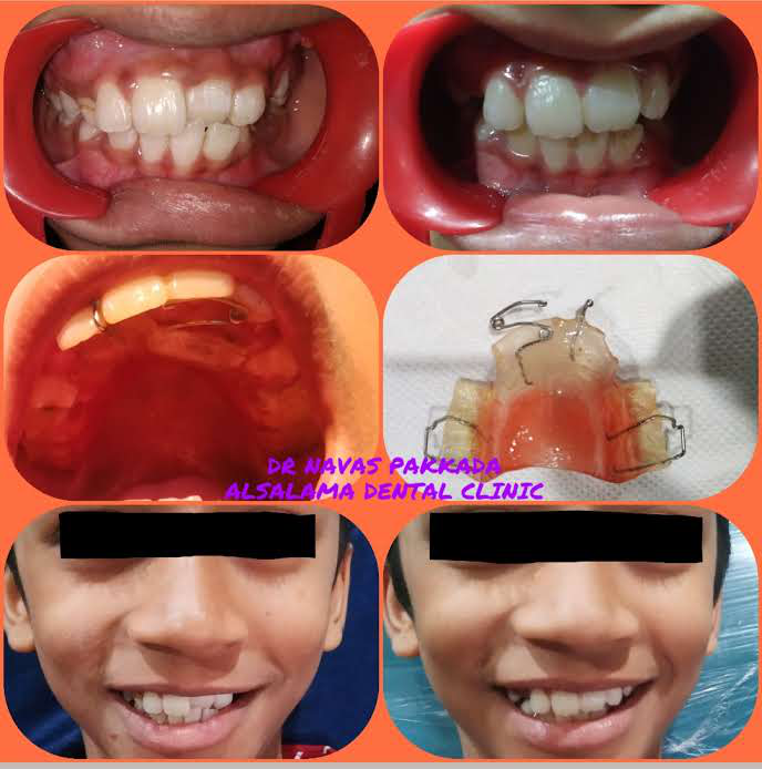 Anterior crossbite correction